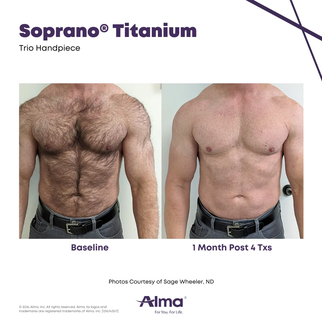 Soprano ICE Platinum before and after. Photo courtesy of Alma