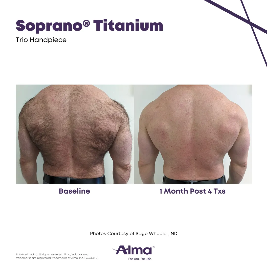 Soprano ICE Platinum before and after. Photo courtesy of Alma